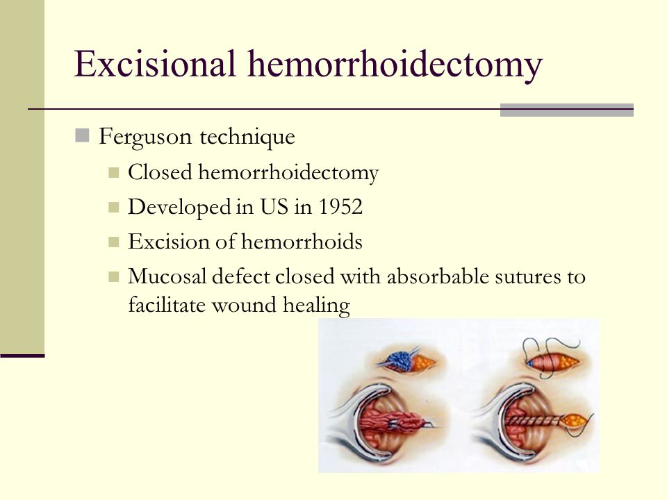 Updates on the Treatment of Hemorrhoidal Disease ppt video